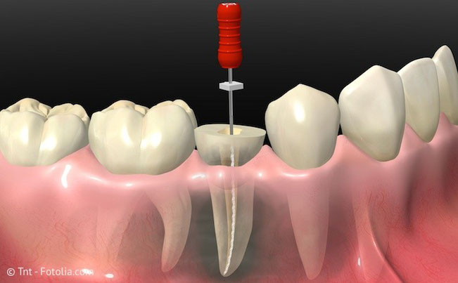 Wurzelbehandlung im Zahn