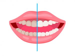 Professionelle Zahnreinigung- vorher & nachher