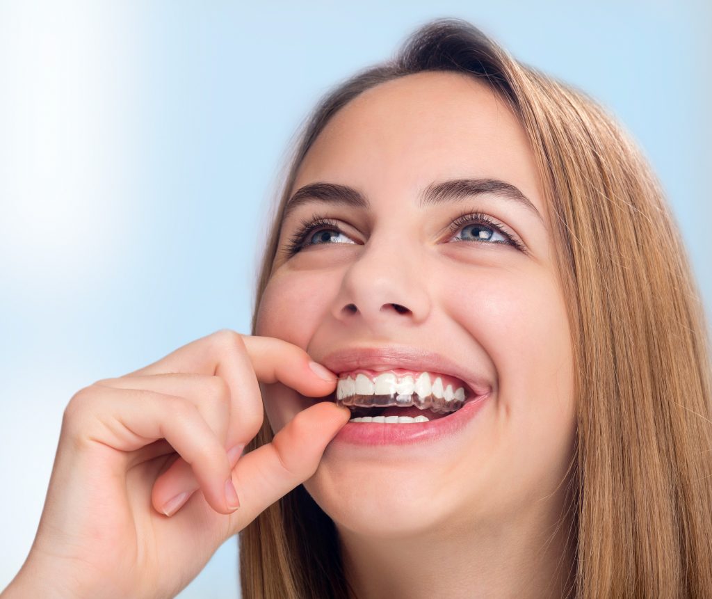 Invisalign - gerade Zähne durch Zahnkorrektur