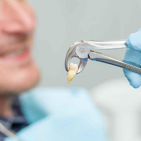Zahn ziehen: Zahnextration beim Zahnarzt